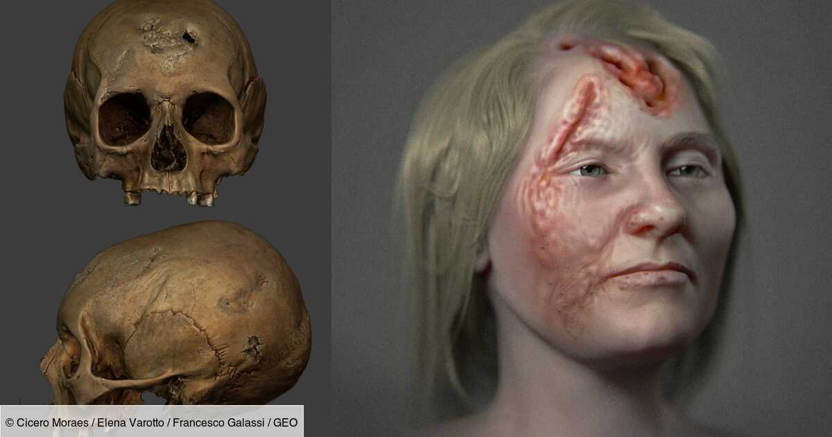 Le visage d'une Islandaise ravagé par la syphilis il y a 500 ans reconstruit en 3D