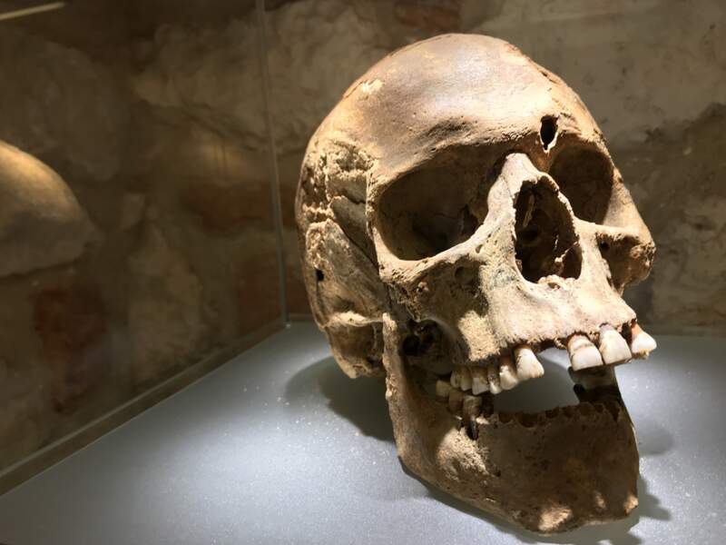 Un crâne du XIe siècle, dont le propriétaire a manifestement subi une trépanation (réussie !) de son vivant